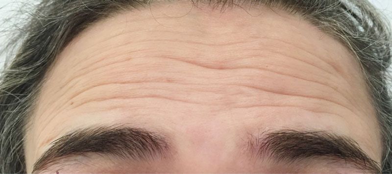 dentista en Mahón, clínica dental en Mahón, cirugía estética en Mahón, botox en Mahón, peeling en Mahón, Antiaging Facial no invasivo en Mahón, rellenos en Mahón, dentista a Maó, clínica dental a Maó, Cirurgia Estètica a Maó, botox a Maó, peeling a Maó, antiaging facial no invasiu a Maó, farciments a Maó