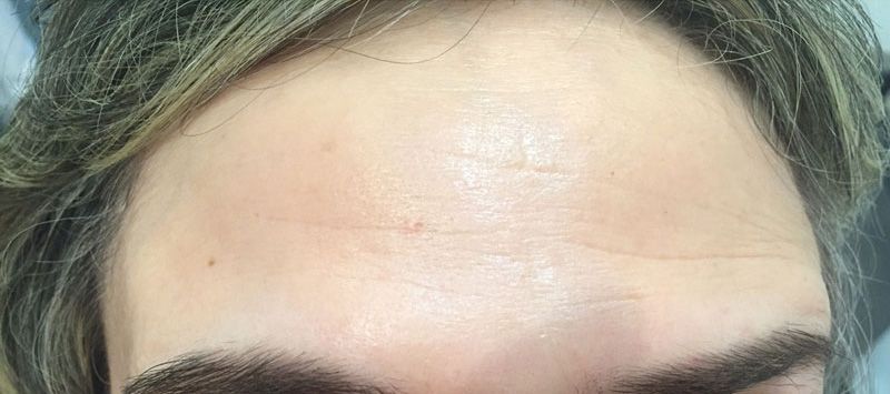 dentista en Mahón, clínica dental en Mahón, cirugía estética en Mahón, botox en Mahón, peeling en Mahón, Antiaging Facial no invasivo en Mahón, rellenos en Mahón, dentista a Maó, clínica dental a Maó, Cirurgia Estètica a Maó, botox a Maó, peeling a Maó, antiaging facial no invasiu a Maó, farciments a Maó