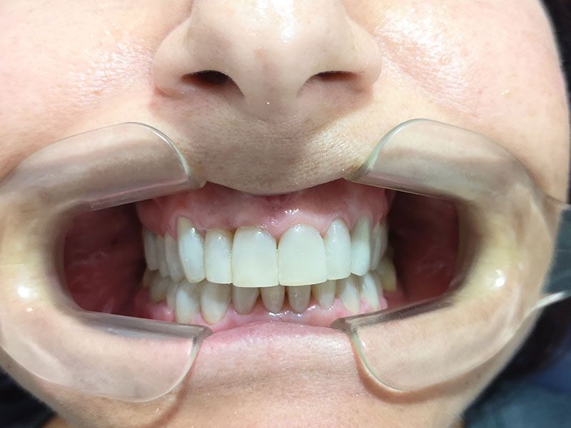 dental veneers in Mahón, dental aesthetics in Mahón, dentist in Mahón, dental clinic in Mahón