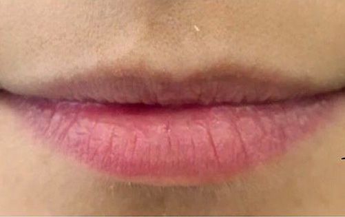 dentista en Mahón, clínica dental en Mahón, cirugía estética en Mahón, botox en Mahón, peeling en Mahón, Antiaging Facial no invasivo en Mahón, rellenos en Mahón, dentista a Maó, clínica dental a Maó, Cirurgia Estètica a Maó, botox a Maó, peeling a Maó, antiaging facial no invasiu a Maó, farciments a Maó