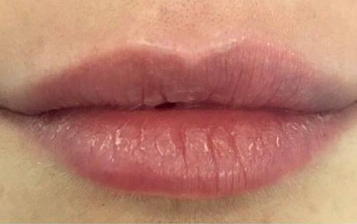 dentista en Mahón, clínica dental en Mahón, cirugía estética en Mahón, botox en Mahón, peeling en Mahón, Antiaging Facial no invasivo en Mahón, rellenos en Mahón, dentista a Maó, clínica dental a Maó, Cirurgia Estètica a Maó, botox a Maó, peeling a Maó, antiaging facial no invasiu a Maó, farciments a Maó