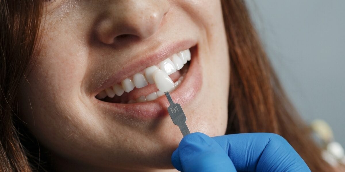 mitos sobre las carillas dentales y diseño de sonrisa