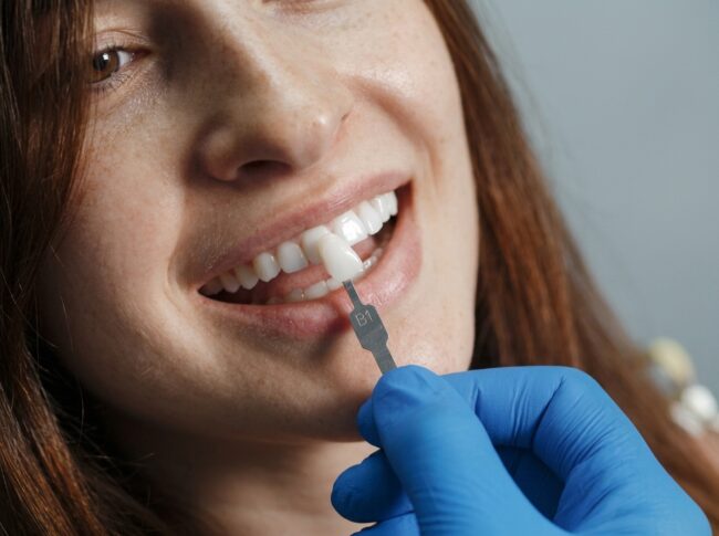 mitos sobre las carillas dentales y diseño de sonrisa